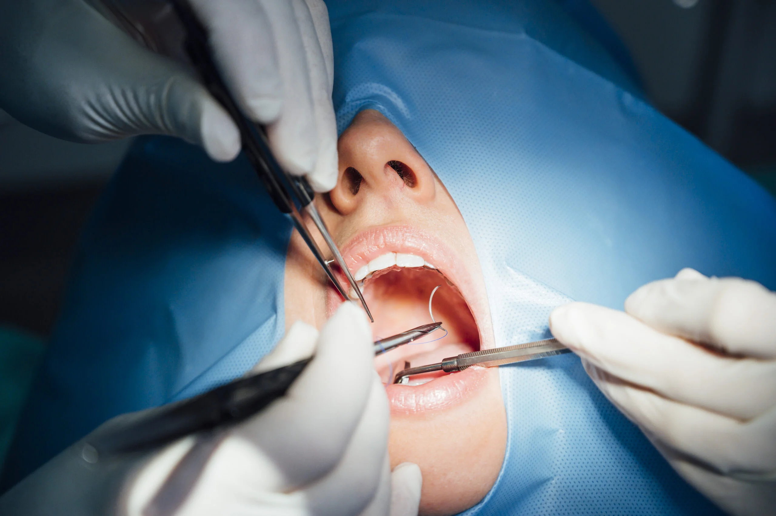 Minor Oral Surgery in Kuala Lumpur