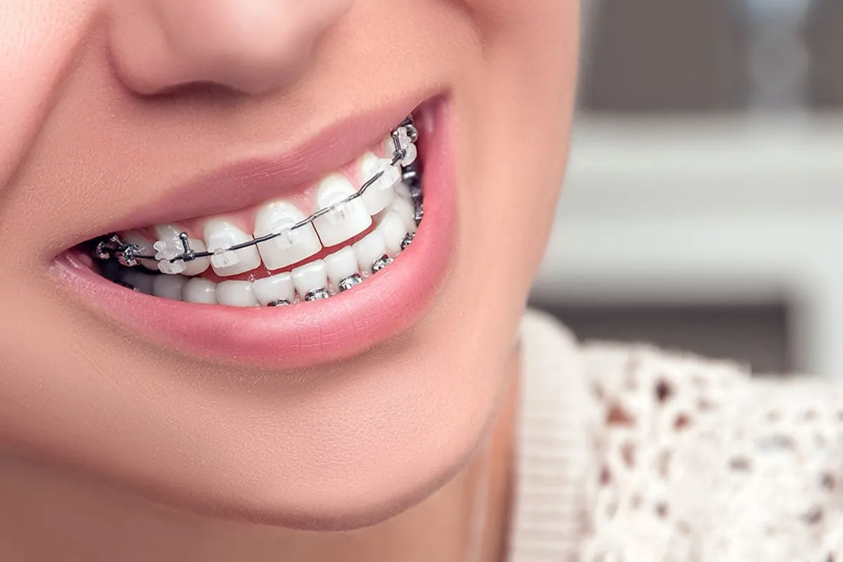 Ceramic Braces malaysia