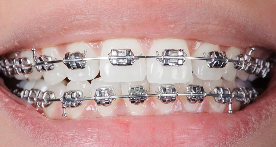 Braces Price in Malaysia