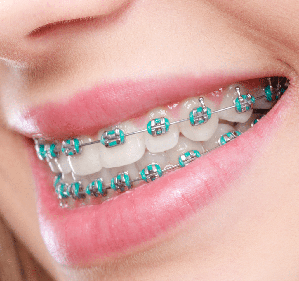 braces price