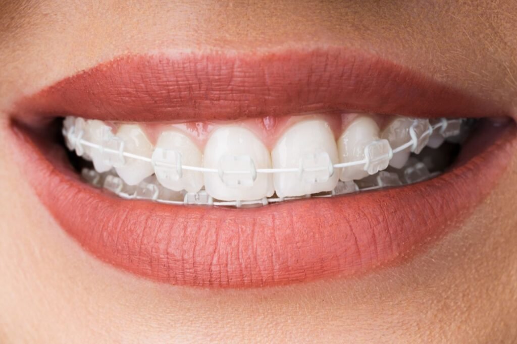 ceramic braces