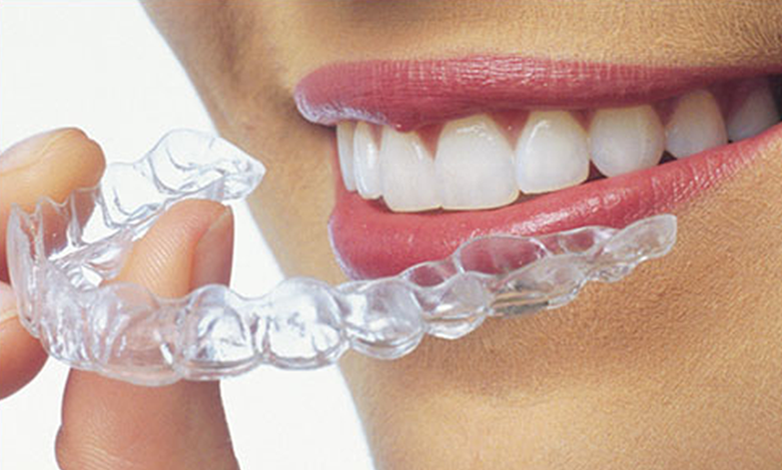 clear aligners