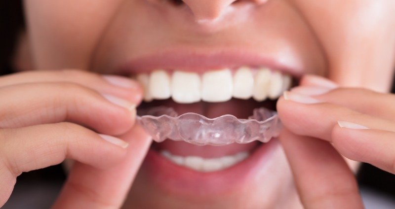 Retainer Braces 101: Your Guide to a Perfect Smile 2024