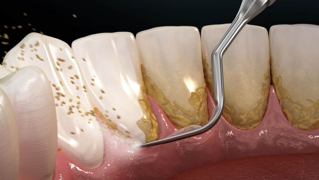 scaling teeth