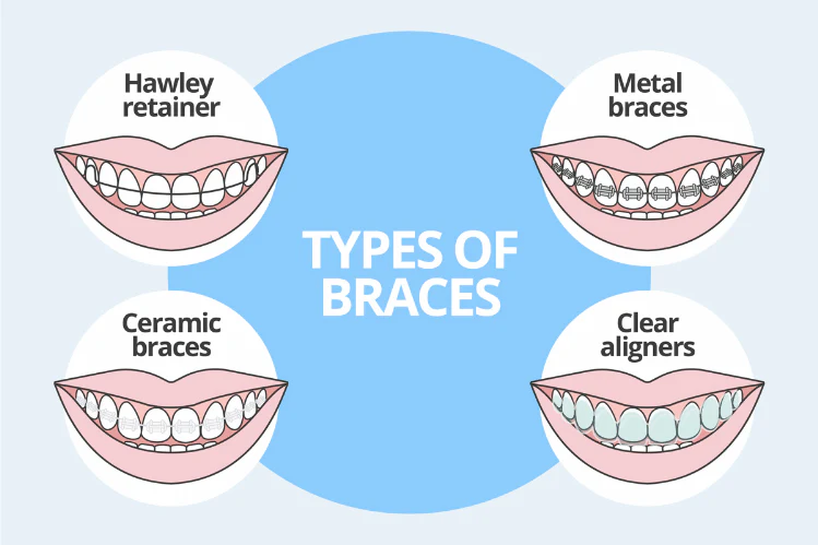 types of braces