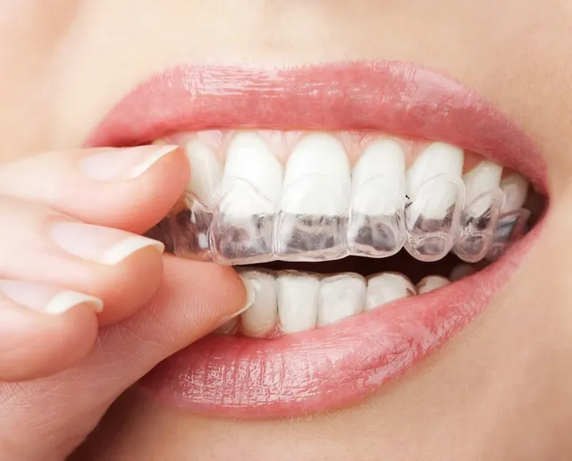 what is retainer braces archident