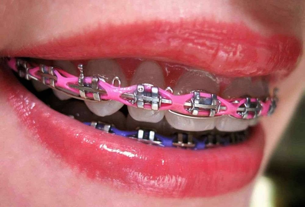 Power Chain Braces Guide: Types, Benefits & Tips