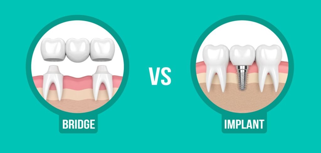 Dental Implants vs Bridges